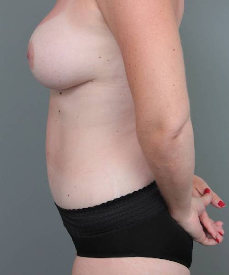 Mommy Makeover Before & After Gallery - Patient 896093 - Image 6 - Scott Chapin, MD