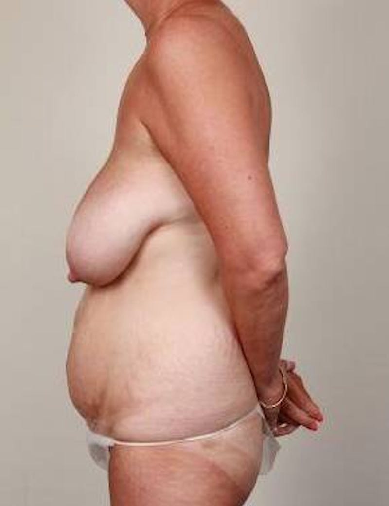 Mommy Makeover Before & After Gallery - Patient 458202 - Image 3 - Scott Chapin, MD