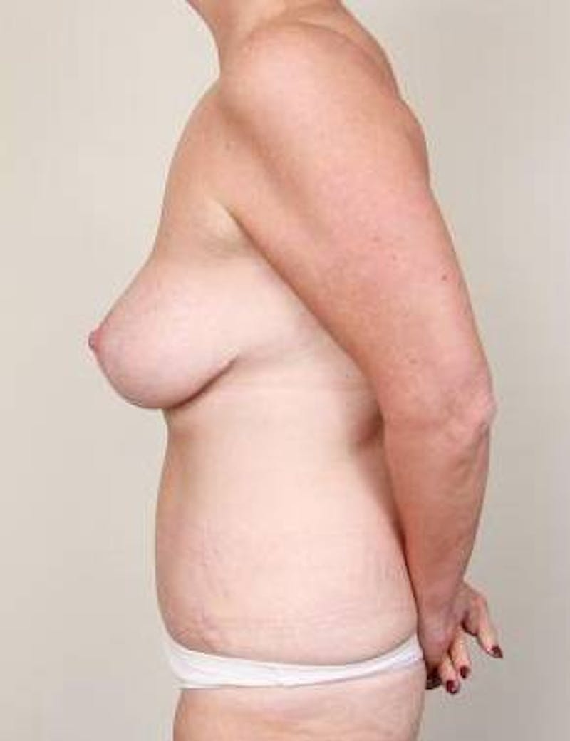 Mommy Makeover Before & After Gallery - Patient 458202 - Image 4 - Scott Chapin, MD