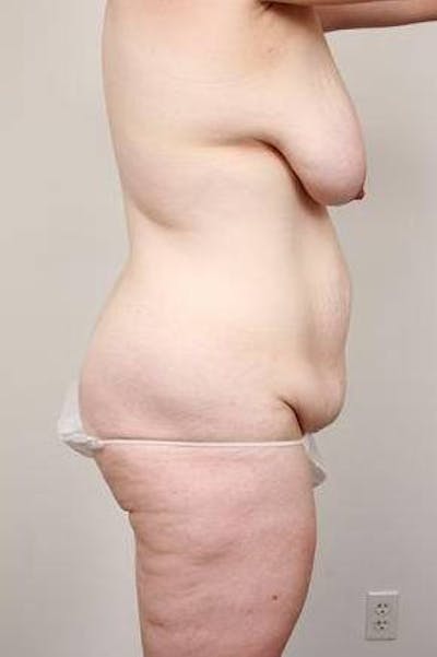 Mommy Makeover Before & After Gallery - Patient 259606 - Image 1 - Scott Chapin, MD
