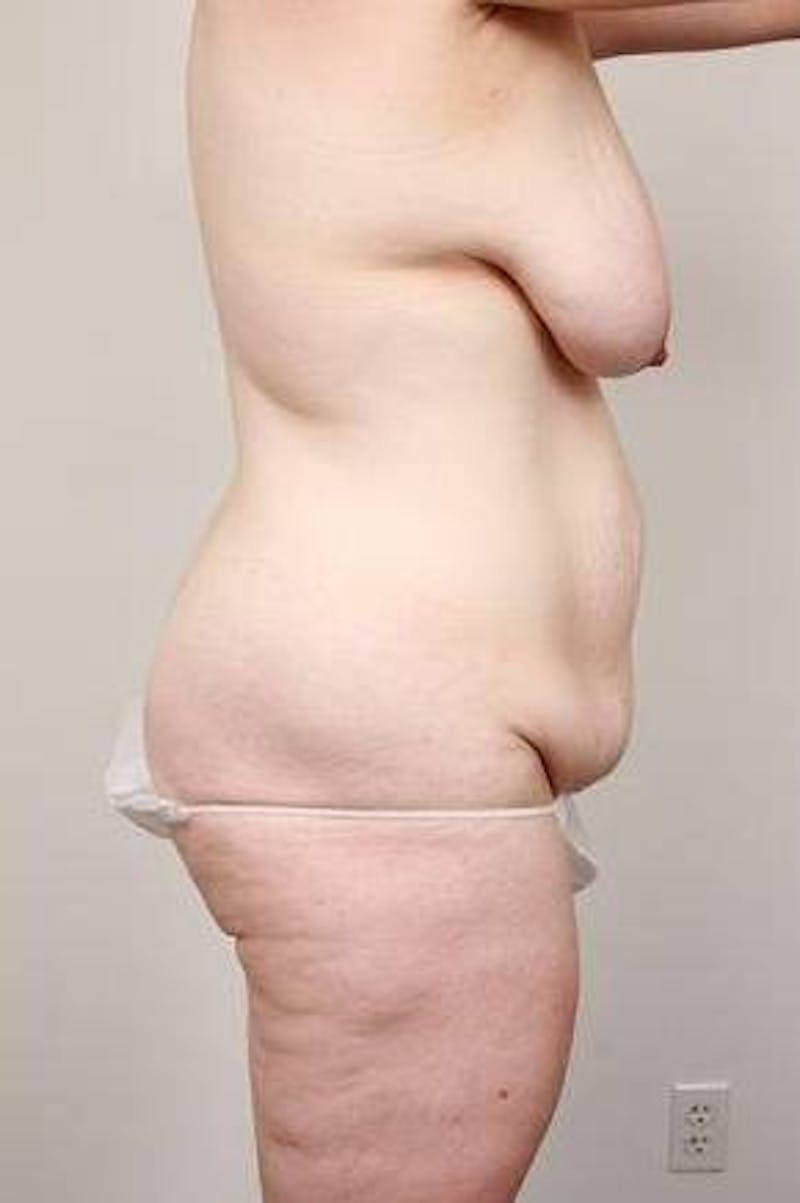 Mommy Makeover Before & After Gallery - Patient 259606 - Image 1 - Scott Chapin, MD
