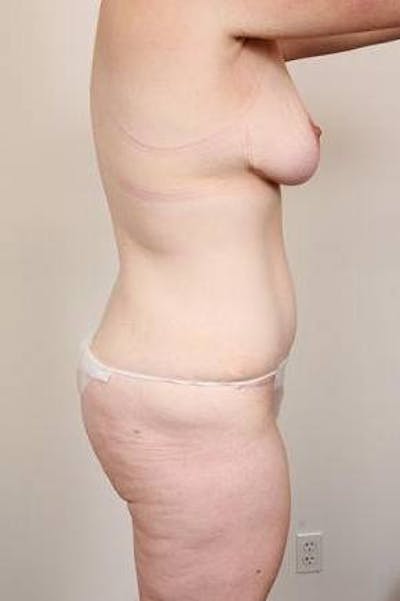 Mommy Makeover Before & After Gallery - Patient 259606 - Image 2 - Scott Chapin, MD