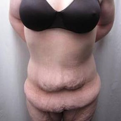 Massive Weight Loss Before & After Gallery - Patient 370882 - Image 1 - Scott Chapin, MD