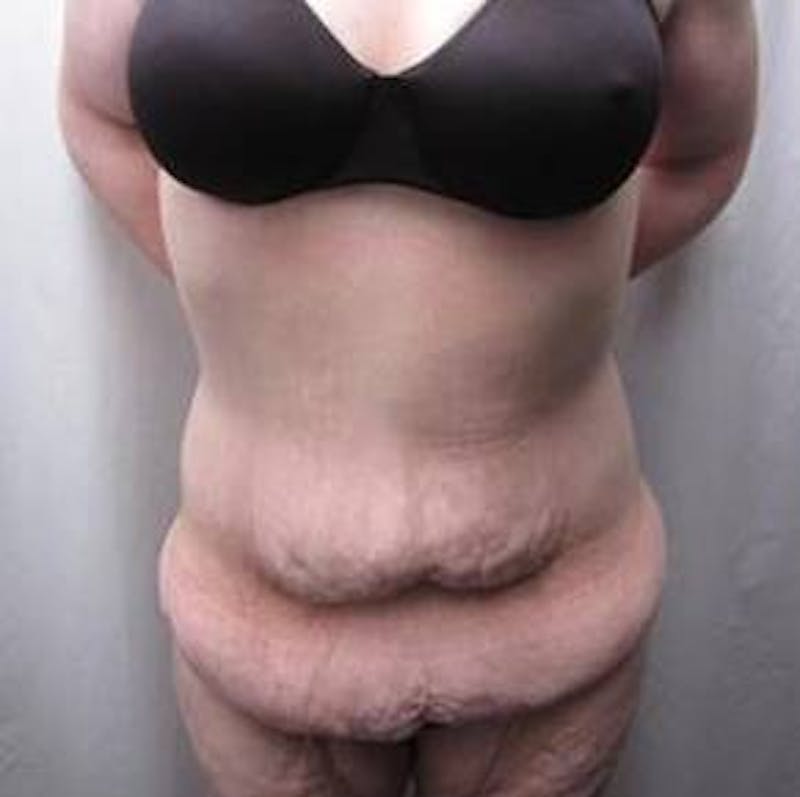 Massive Weight Loss Before & After Gallery - Patient 370882 - Image 1 - Scott Chapin, MD
