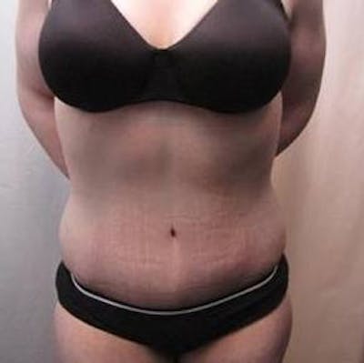Massive Weight Loss Before & After Gallery - Patient 370882 - Image 2 - Scott Chapin, MD