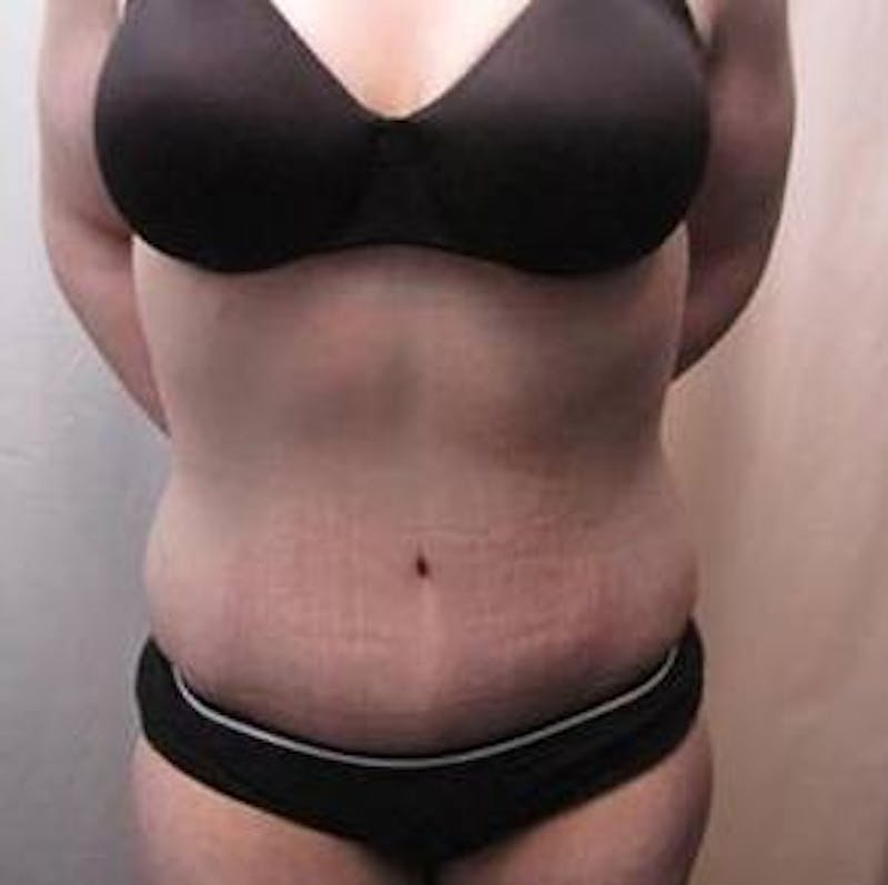 Massive Weight Loss Before & After Gallery - Patient 370882 - Image 2 - Scott Chapin, MD