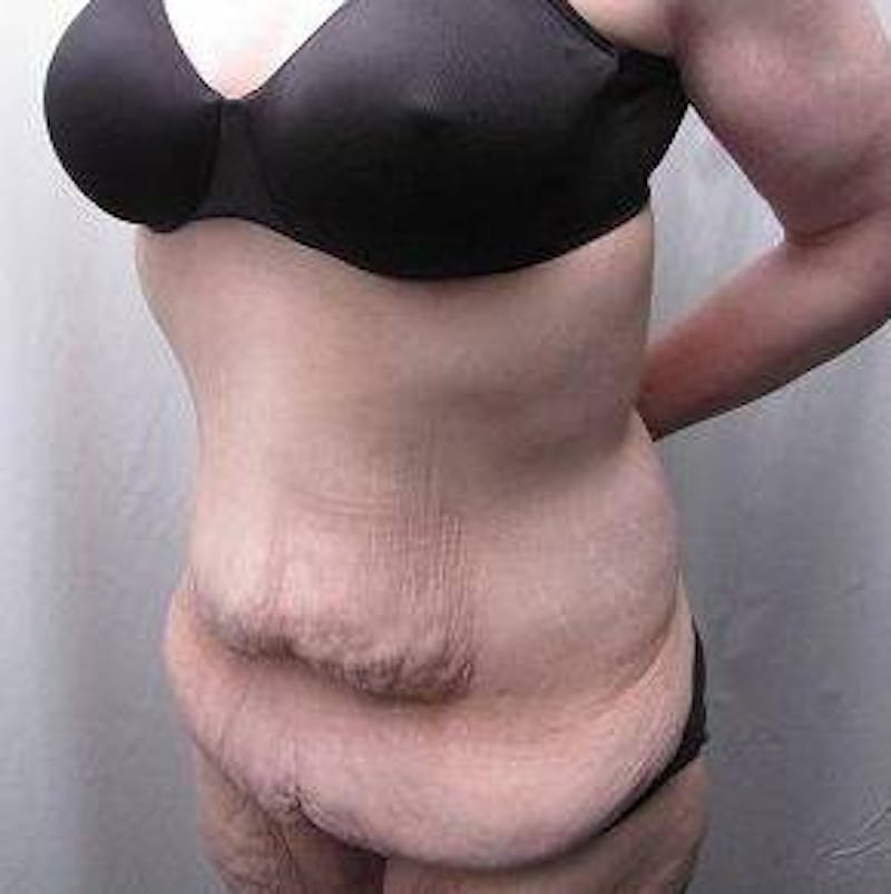 Massive Weight Loss Before & After Gallery - Patient 370882 - Image 3 - Scott Chapin, MD