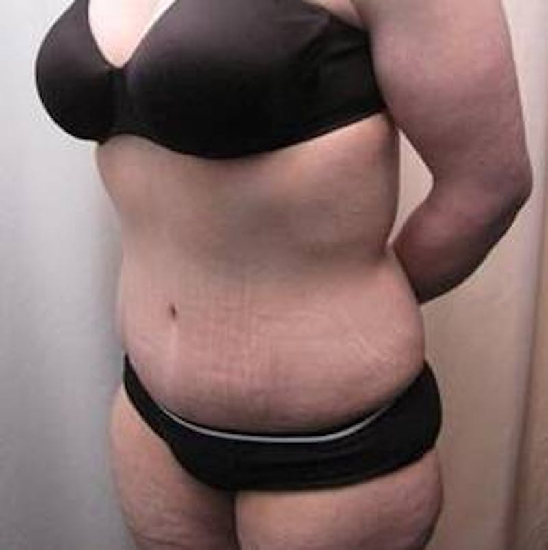 Massive Weight Loss Before & After Gallery - Patient 370882 - Image 4 - Scott Chapin, MD