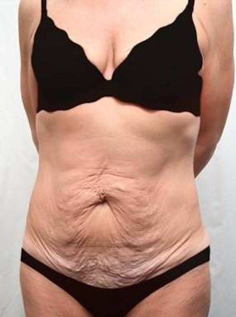 Massive Weight Loss Before & After Gallery - Patient 321074 - Image 1 - Scott Chapin, MD
