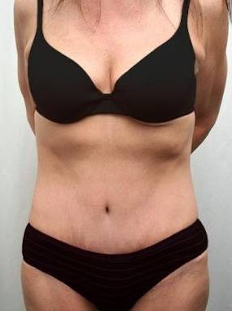 Massive Weight Loss Before & After Gallery - Patient 321074 - Image 2 - Scott Chapin, MD