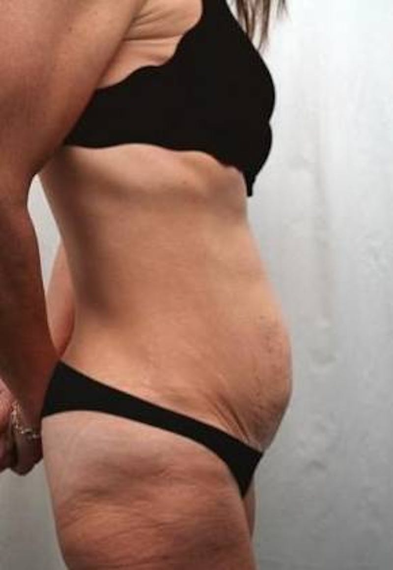 Massive Weight Loss Before & After Gallery - Patient 321074 - Image 3 - Scott Chapin, MD