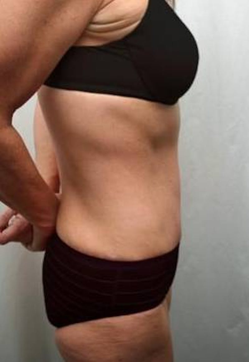 Massive Weight Loss Before & After Gallery - Patient 321074 - Image 4 - Scott Chapin, MD