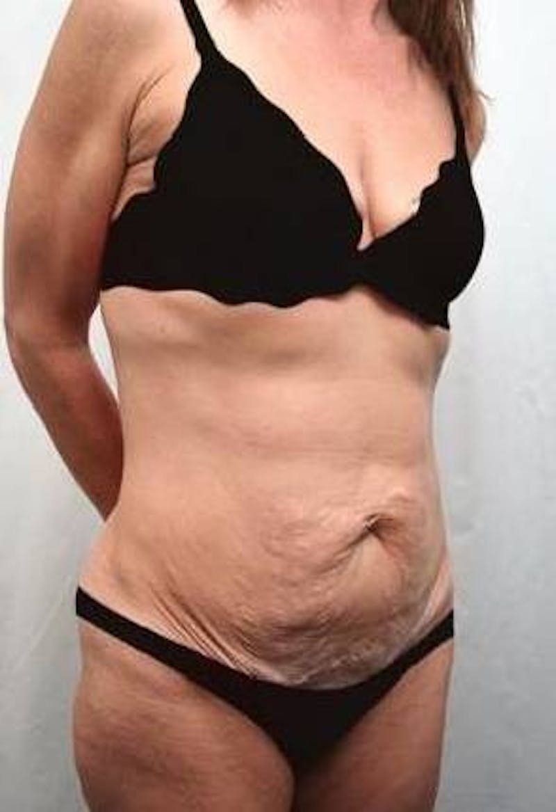 Massive Weight Loss Before & After Gallery - Patient 321074 - Image 5 - Scott Chapin, MD