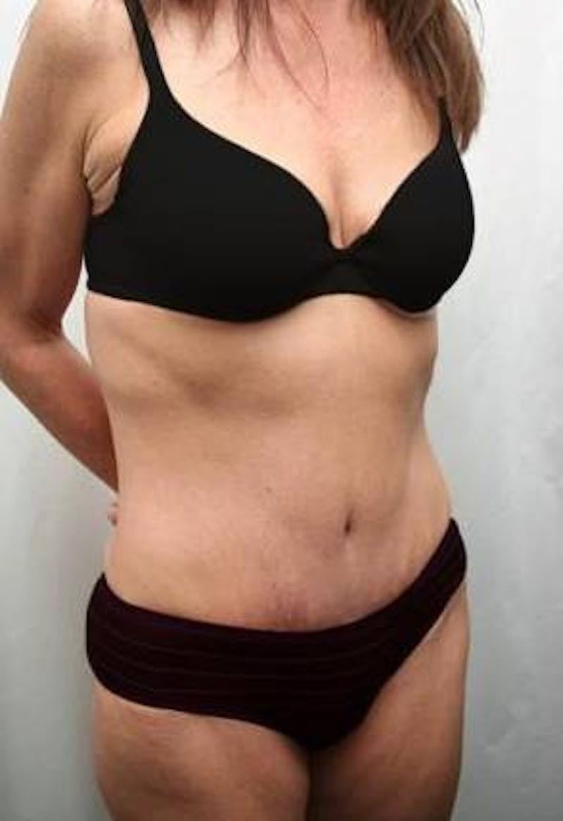Massive Weight Loss Before & After Gallery - Patient 321074 - Image 6 - Scott Chapin, MD