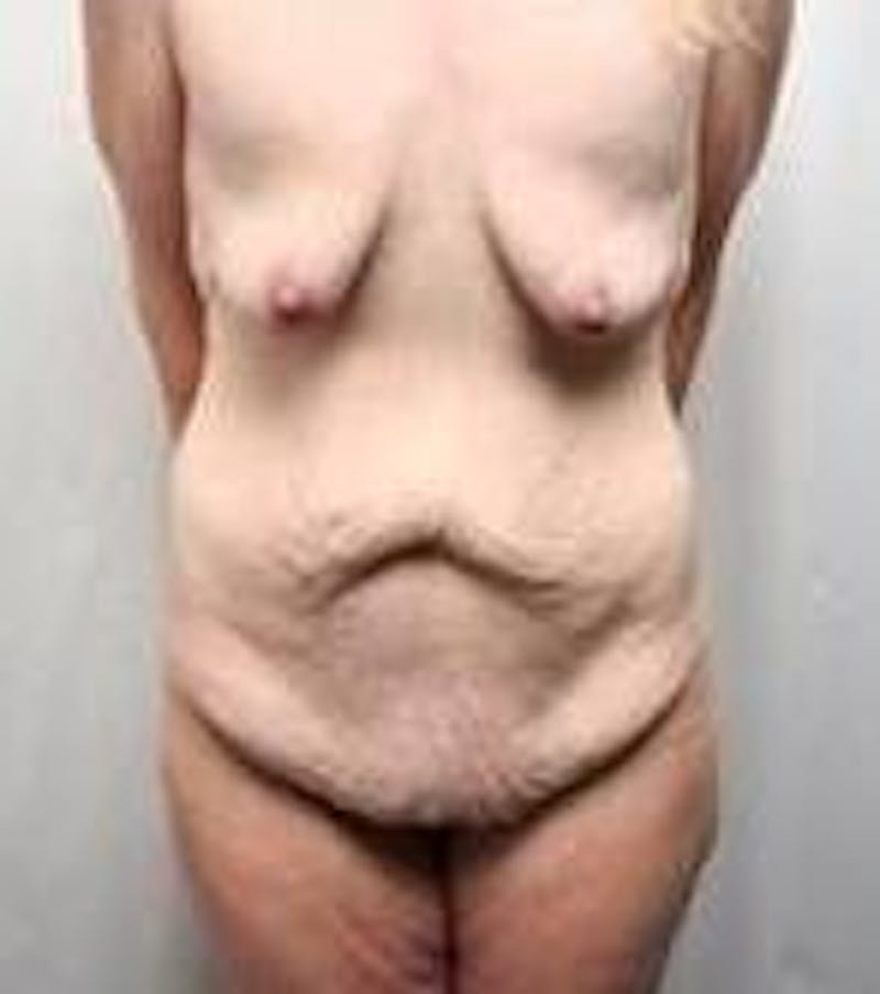 Lower Body Lift Before & After Gallery - Patient 294053 - Image 1 - Scott Chapin, MD