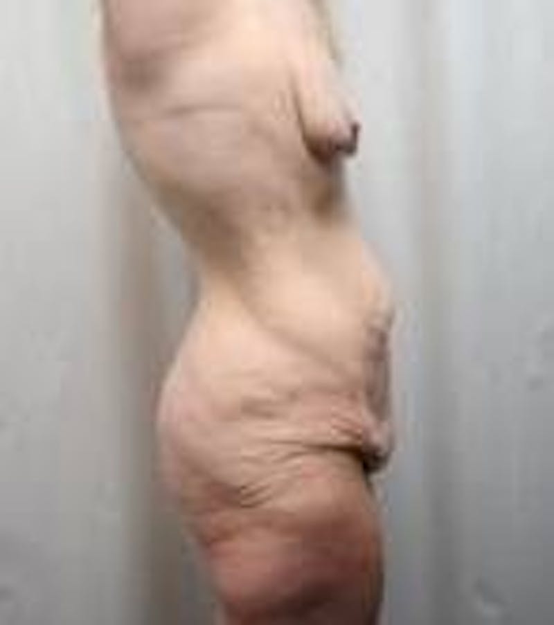 Lower Body Lift Before & After Gallery - Patient 294053 - Image 3 - Scott Chapin, MD