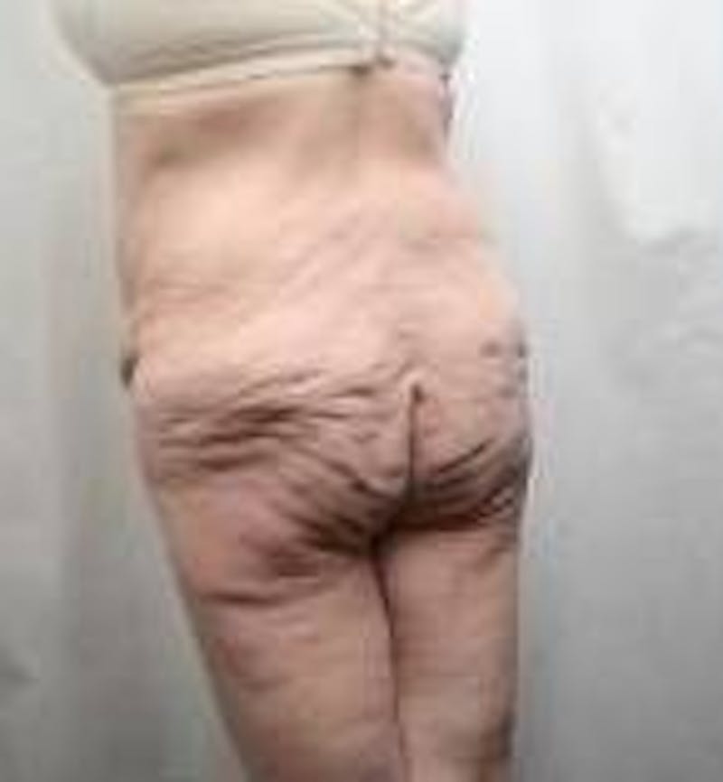 Massive Weight Loss Before & After Gallery - Patient 419659 - Image 1 - Scott Chapin, MD