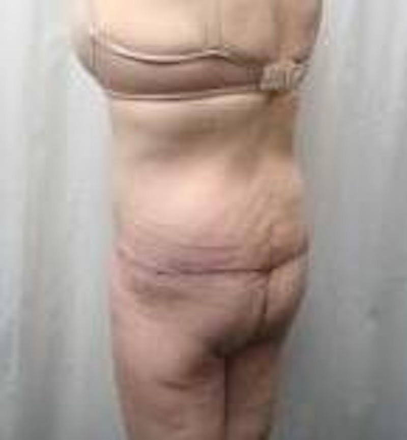 Massive Weight Loss Before & After Gallery - Patient 419659 - Image 2 - Scott Chapin, MD
