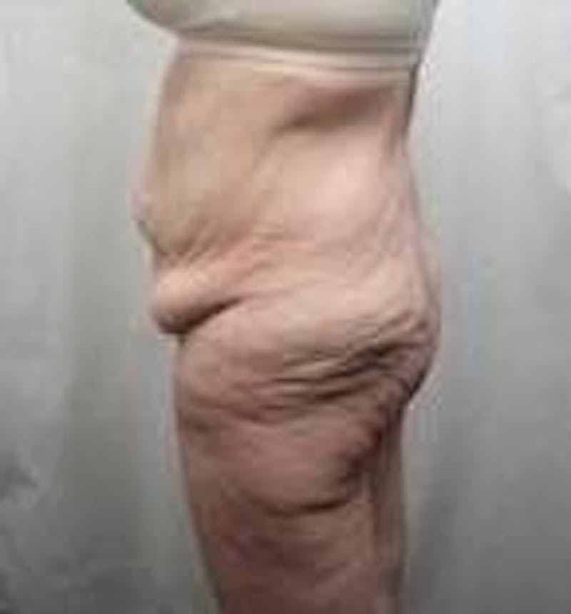 Massive Weight Loss Before & After Gallery - Patient 419659 - Image 3 - Scott Chapin, MD
