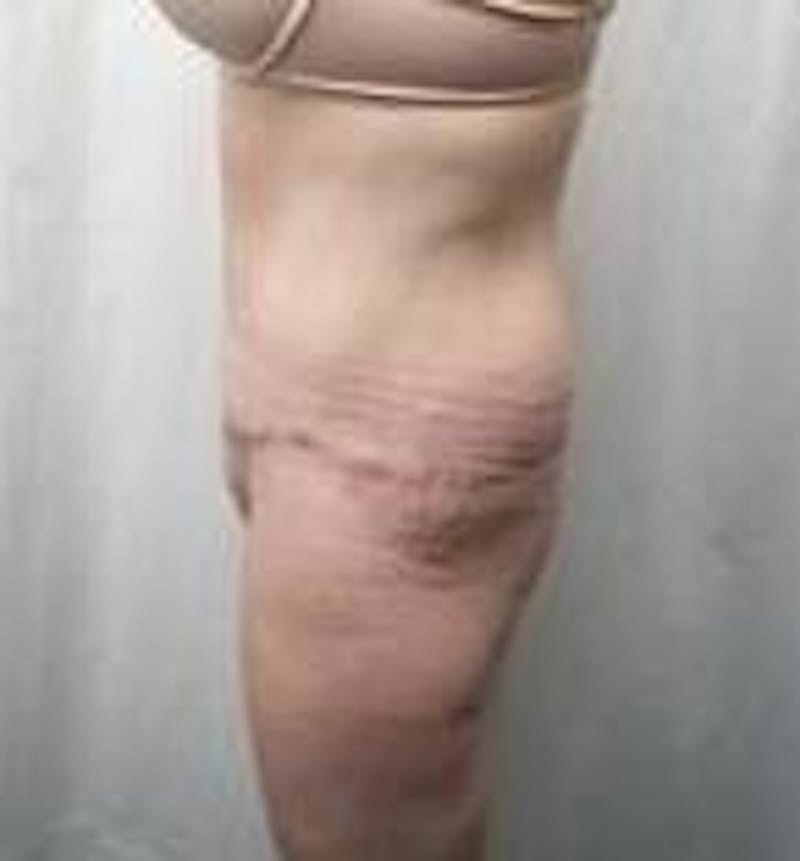 Massive Weight Loss Before & After Gallery - Patient 419659 - Image 4 - Scott Chapin, MD