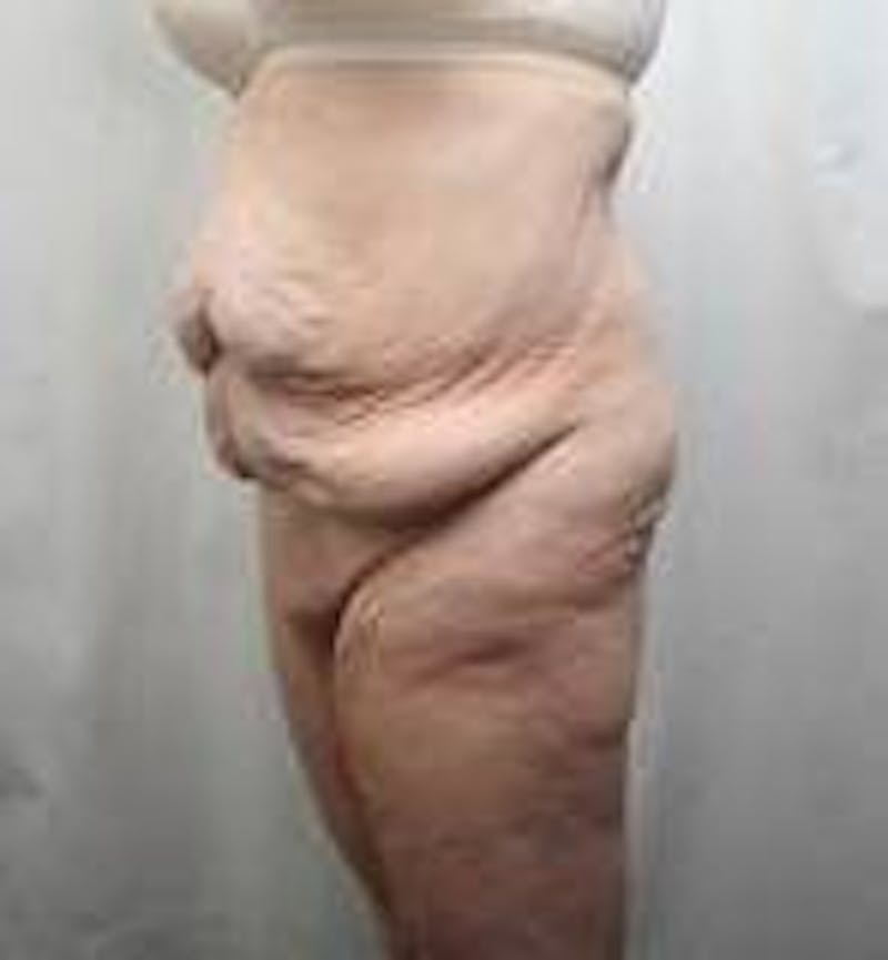 Massive Weight Loss Before & After Gallery - Patient 419659 - Image 5 - Scott Chapin, MD