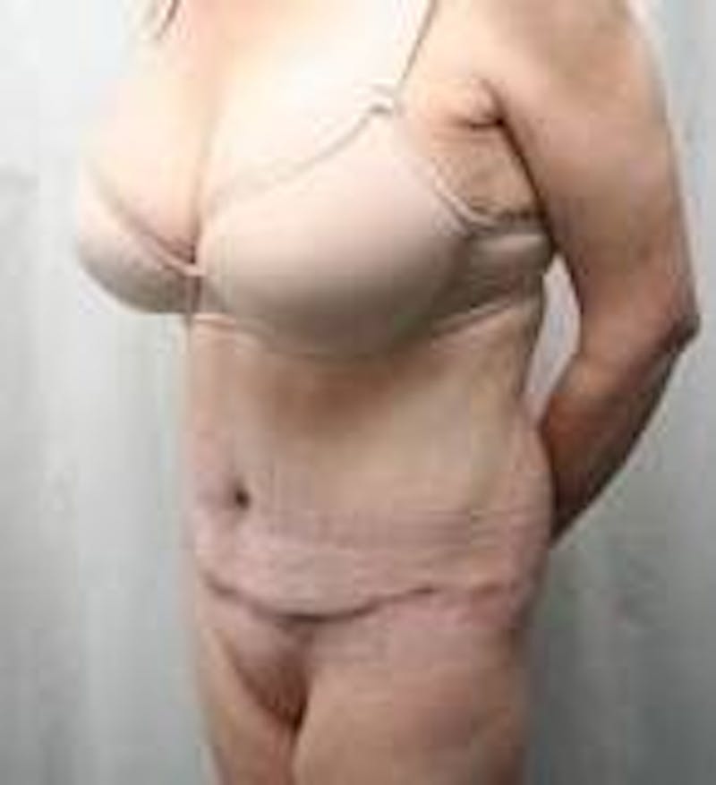 Massive Weight Loss Before & After Gallery - Patient 419659 - Image 6 - Scott Chapin, MD
