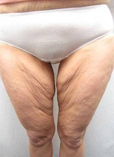 Massive Weight Loss Before & After Gallery - Patient 196740 - Image 1 - Scott Chapin, MD