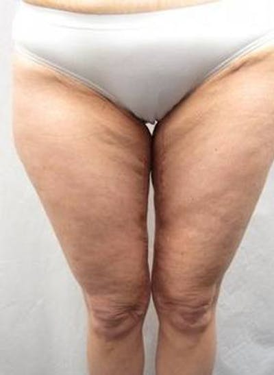 Massive Weight Loss Before & After Gallery - Patient 196740 - Image 2 - Scott Chapin, MD