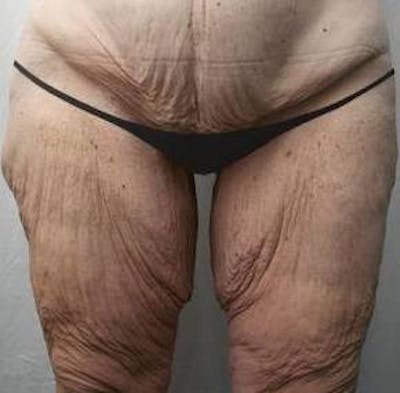 Massive Weight Loss Before & After Gallery - Patient 353742 - Image 1 - Scott Chapin, MD