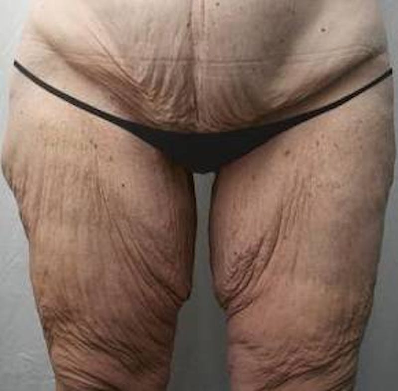 Massive Weight Loss Before & After Gallery - Patient 353742 - Image 1 - Scott Chapin, MD