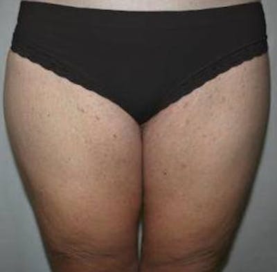Massive Weight Loss Before & After Gallery - Patient 353742 - Image 2 - Scott Chapin, MD