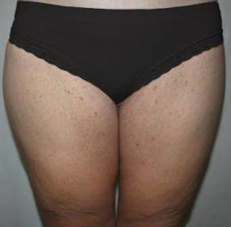 Massive Weight Loss Before & After Gallery - Patient 353742 - Image 2 - Scott Chapin, MD