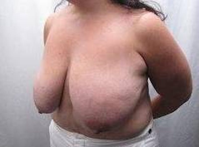 Massive Weight Loss Before & After Gallery - Patient 485686 - Image 1 - Scott Chapin, MD