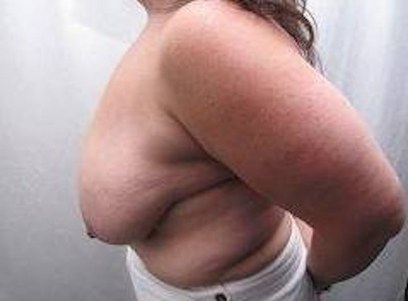 Massive Weight Loss Before & After Gallery - Patient 485686 - Image 3 - Scott Chapin, MD