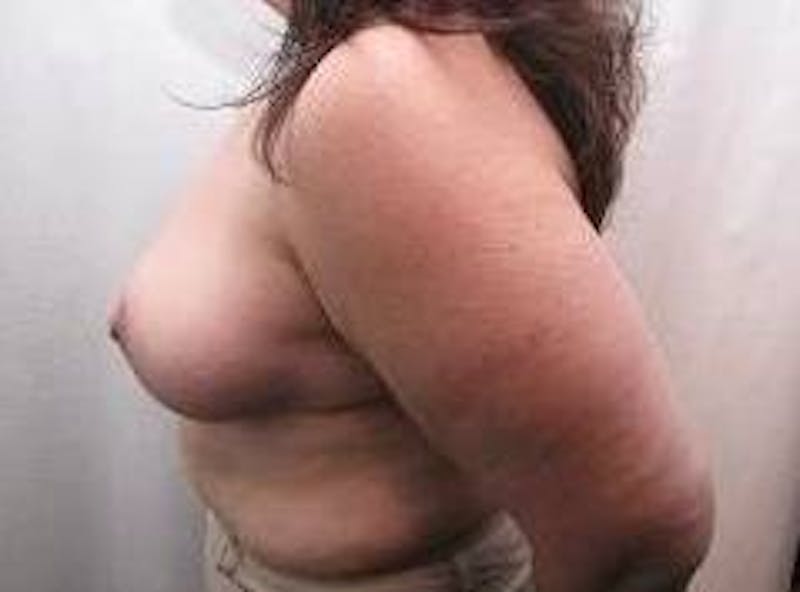 Massive Weight Loss Before & After Gallery - Patient 485686 - Image 4 - Scott Chapin, MD