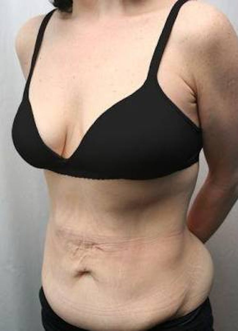 Massive Weight Loss Before & After Gallery - Patient 333919 - Image 1 - Scott Chapin, MD