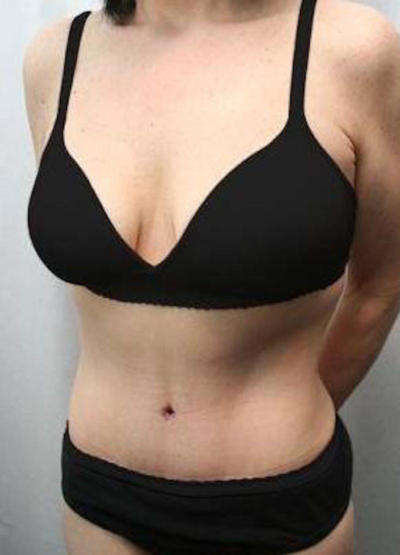 Massive Weight Loss Before & After Gallery - Patient 333919 - Image 2 - Scott Chapin, MD