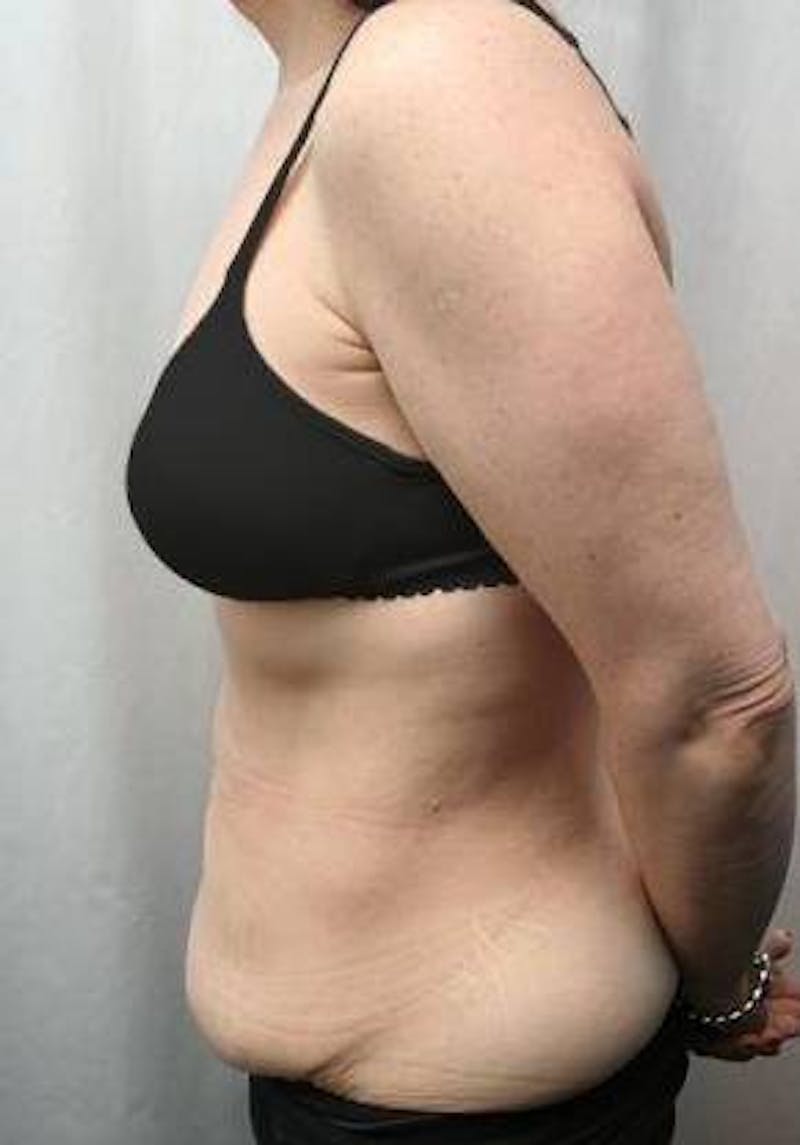Massive Weight Loss Before & After Gallery - Patient 333919 - Image 3 - Scott Chapin, MD
