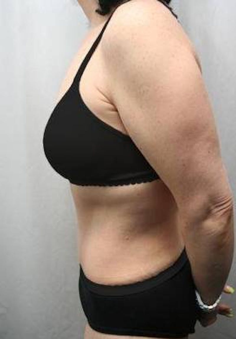 Massive Weight Loss Before & After Gallery - Patient 333919 - Image 4 - Scott Chapin, MD