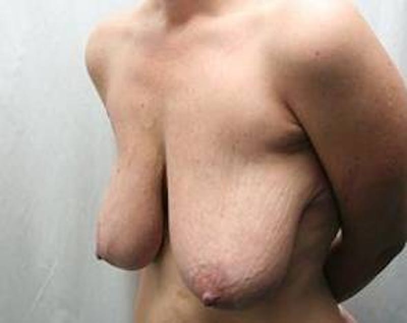 Massive Weight Loss Before & After Gallery - Patient 254168 - Image 5 - Scott Chapin, MD