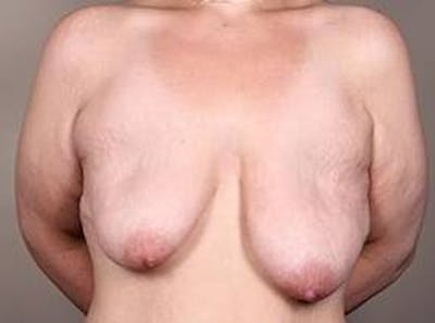 Massive Weight Loss Before & After Gallery - Patient 184727 - Image 1 - Scott Chapin, MD