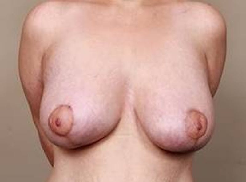 Massive Weight Loss Before & After Gallery - Patient 184727 - Image 2 - Scott Chapin, MD
