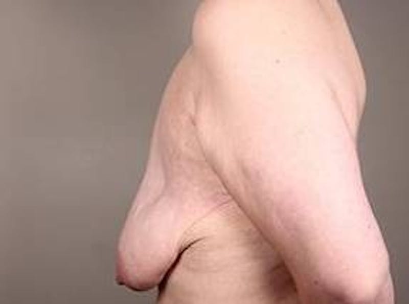 Massive Weight Loss Before & After Gallery - Patient 184727 - Image 3 - Scott Chapin, MD