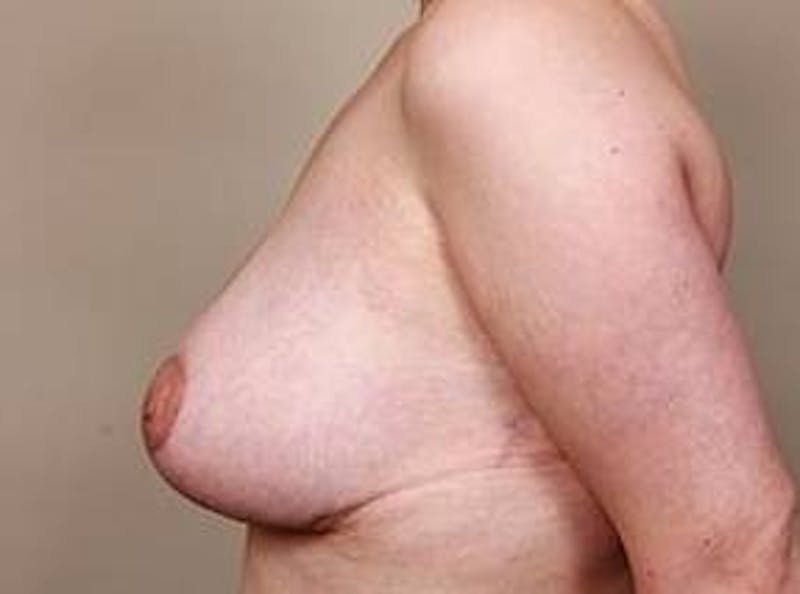 Massive Weight Loss Before & After Gallery - Patient 184727 - Image 4 - Scott Chapin, MD