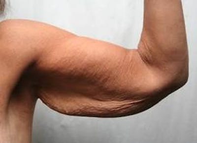 Massive Weight Loss Before & After Gallery - Patient 419337 - Image 1 - Scott Chapin, MD