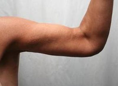 Massive Weight Loss Before & After Gallery - Patient 419337 - Image 2 - Scott Chapin, MD