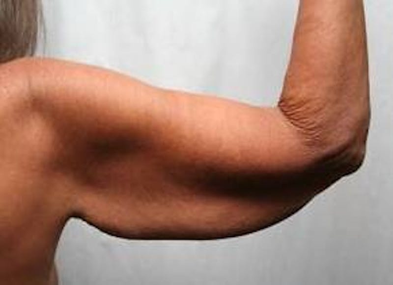 Massive Weight Loss Before & After Gallery - Patient 419337 - Image 3 - Scott Chapin, MD