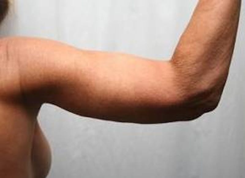 Massive Weight Loss Before & After Gallery - Patient 419337 - Image 4 - Scott Chapin, MD