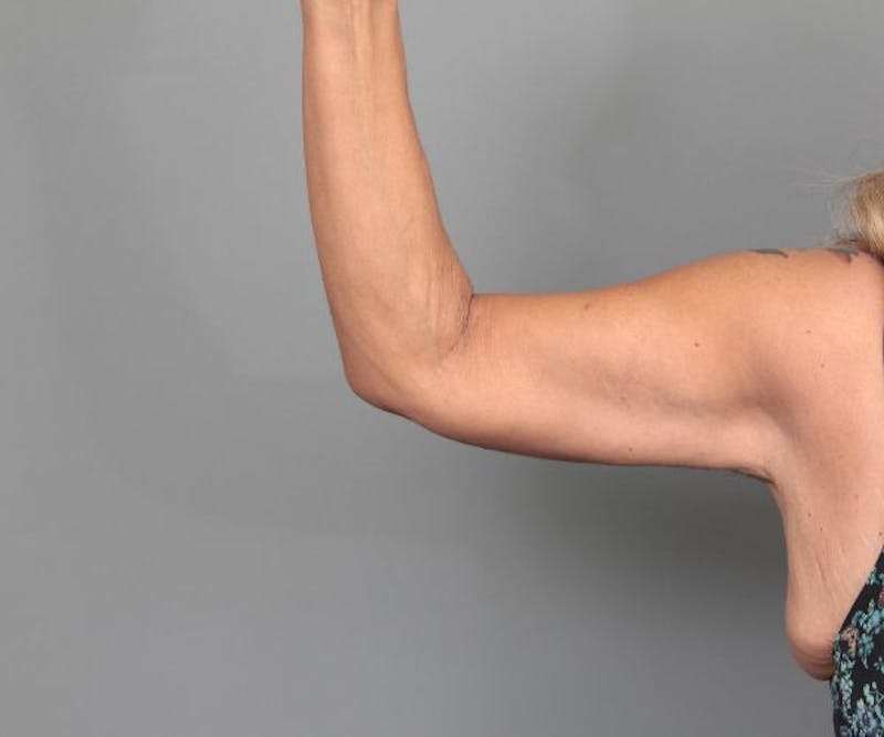 Arm Lift Before & After Gallery - Patient 487002 - Image 2 - Scott Chapin, MD