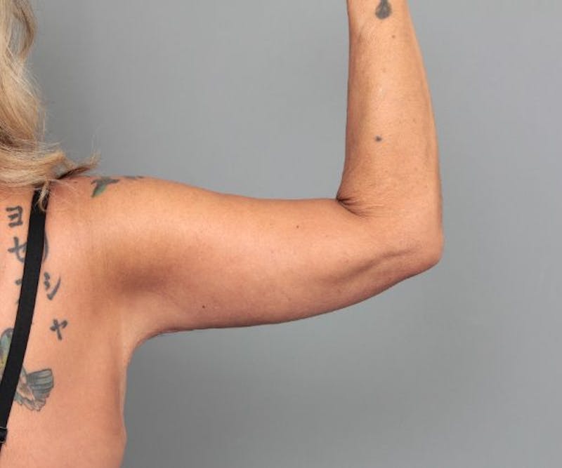 Arm Lift Before & After Gallery - Patient 487002 - Image 4 - Scott Chapin, MD